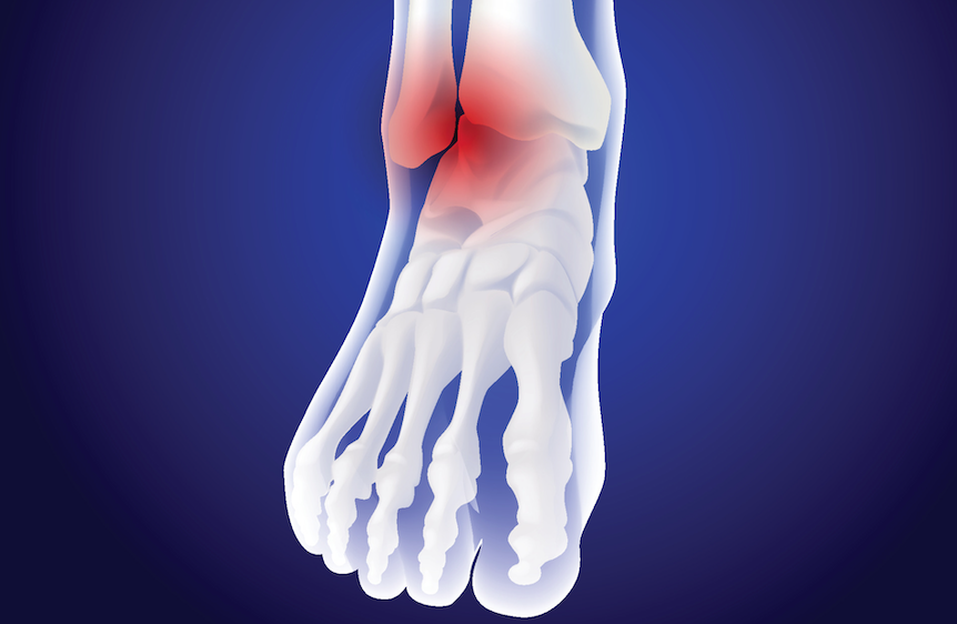 exploring-the-causes-of-sudden-ankle-pain-without-injury-newman-feet