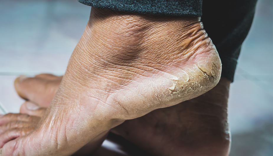 Home Remedies for Heel Cracks Newman Feet