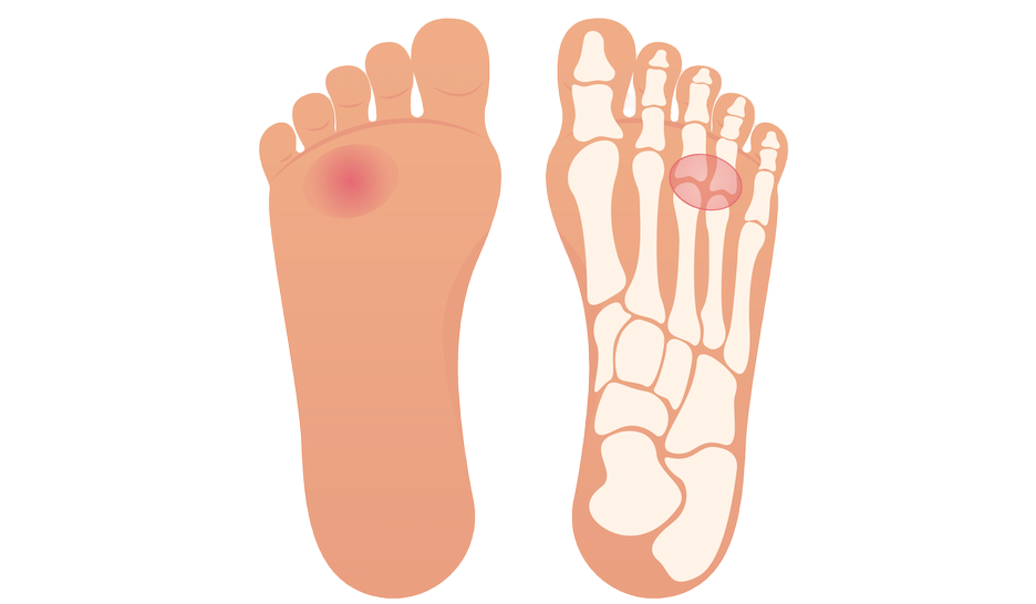 New Treatments for Morton's Neuroma: What You Need to Know - Newman Feet