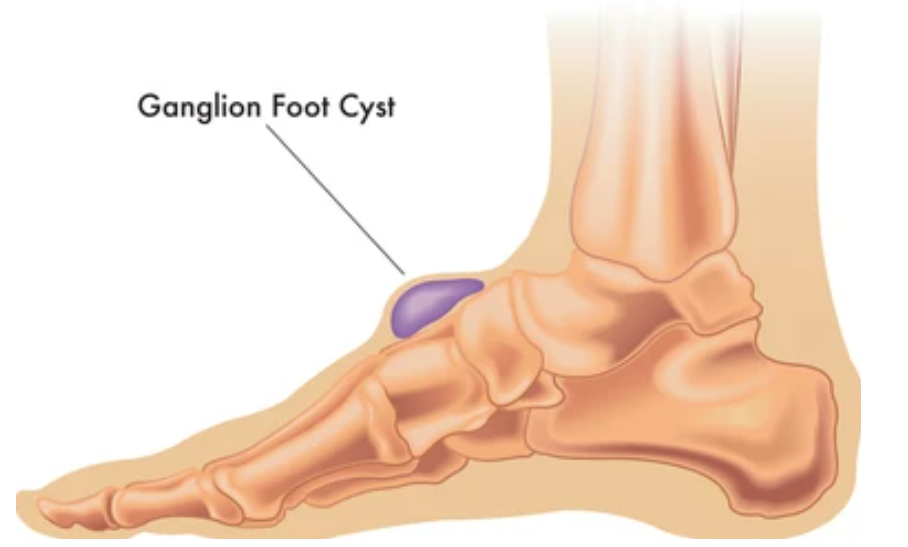 Ganglion Cyst Aspiration: A Comprehensive Guide to Procedure, Recovery ...