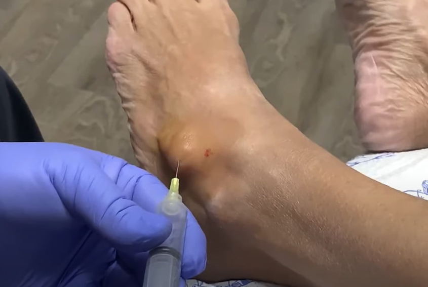 How Is A Ganglion Cyst Diagnosed When On The Foot Newman Feet
