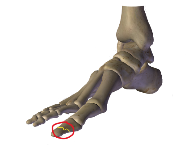 how-do-you-treat-a-stress-fracture-in-your-toe-newman-feet