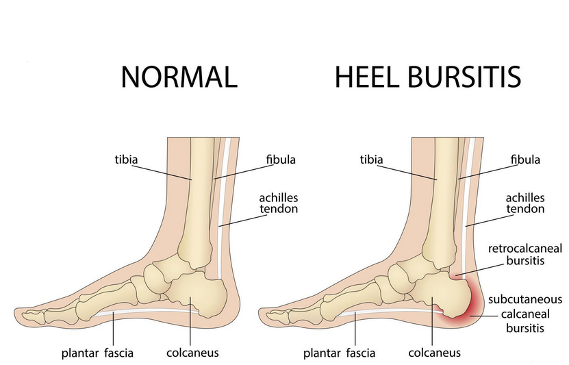 Sudden Heel Pain Without Injury: Understanding and Managing the Unseen ...