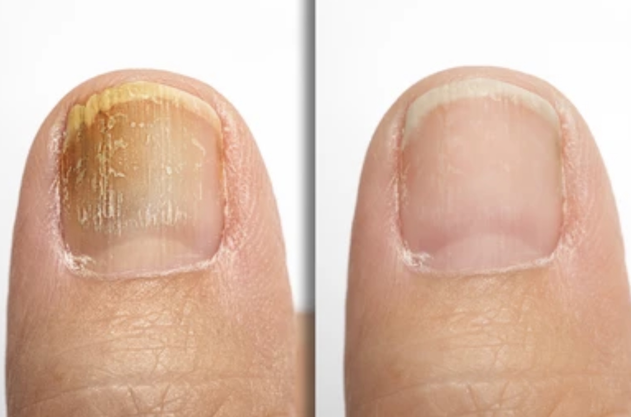 How to Know if Toenail Fungus Is Dying: A Comprehensive Guide - Newman Feet